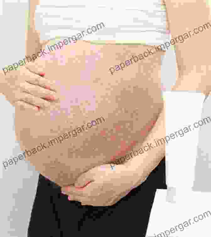 A Woman With A PUPPP Rash On Her Abdomen PUPPP NO MORE: The Ultimate Guide On Treatment And Relief Of PUPPP Rash And Other Pregnancy Rash Such As PUPPS And PEP