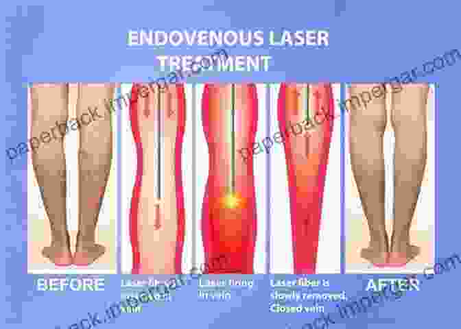 Laser Treatment For Leg Veins How To Stop Ugly Painful Legs: Simple Solutions To Complex Medical Issues #2 Of The Unplugged For Good