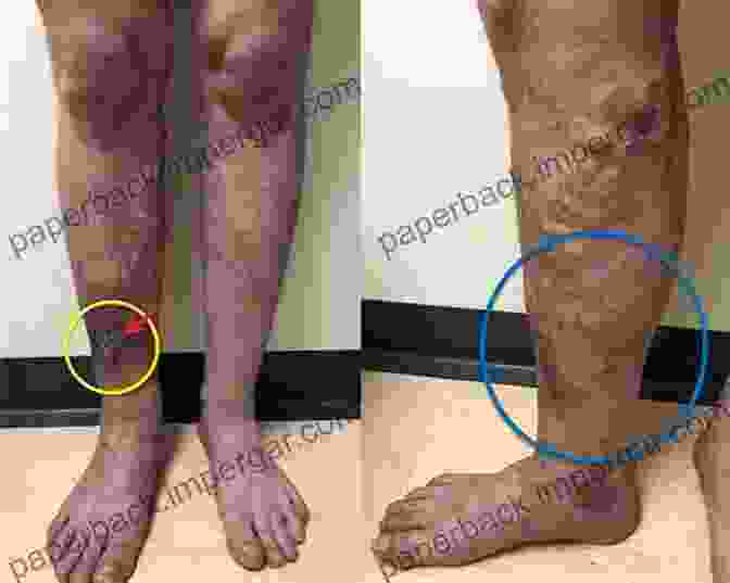 Legs With Visible Swelling How To Stop Ugly Painful Legs: Simple Solutions To Complex Medical Issues #2 Of The Unplugged For Good